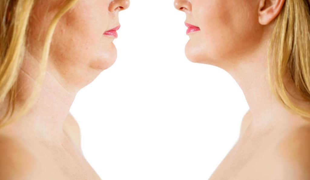 Double Chin treatment Weybridge before and after results
