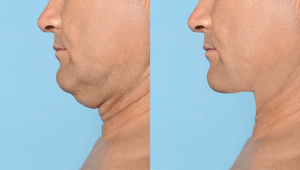 Which Non-Surgical Treatments Work Best for Jowls and Loose Skin Weybridge?
