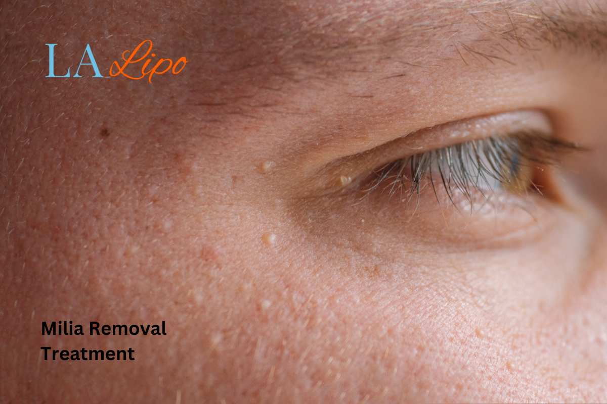 Cryopen Milia Removal: Is It the Easiest and Safest Option Weybridge?