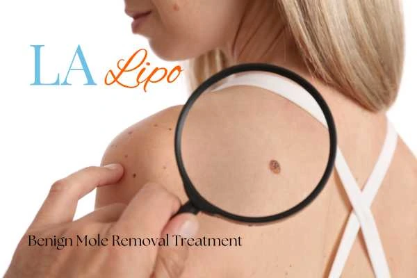 Woman having her inspection of blemish before mole removal Weybridge