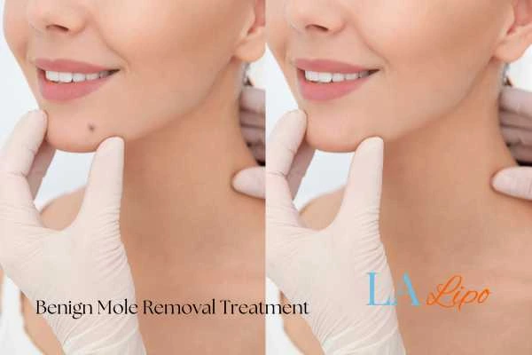 woman's before and after mole removal Weybridge results