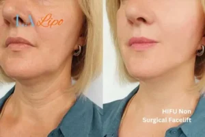 hi-fu for wrinkles Weybridge before and after results