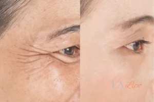 Before and after results of woman - HI-fu wrinkles reduction treatment Weybridge