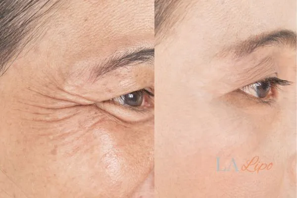 Before and after results of woman - HI-fu wrinkles reduction treatment Weybridge