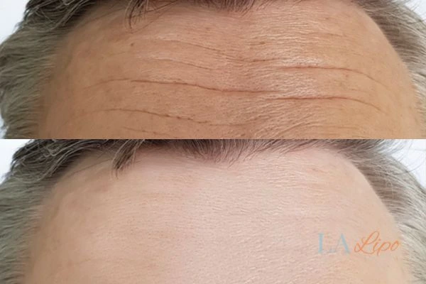 results of HIFU Weybridge on mans forehead to help reduce lines and wrinkles