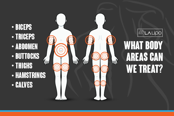 Graphic to show areas you can have LA-EMS Body Sculpting Weybridge treatment.