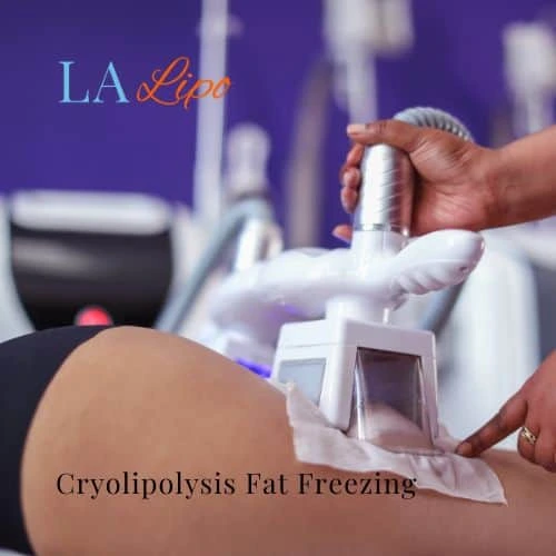 fat freezing - Cryolipolysis Weybridge