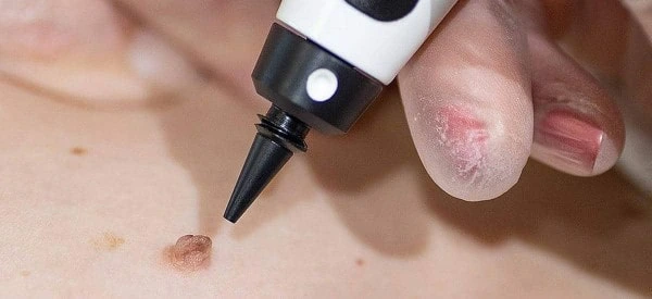 skin tag removal using cryopen Weybridge