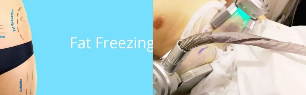 Fat freezing Weybridge on multiple areas of the body