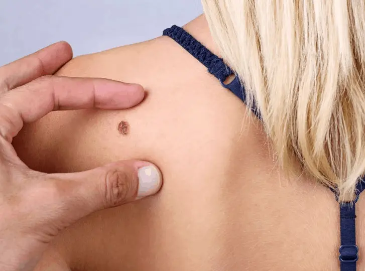 woman having mole removal Weybridge consultation before treatment.