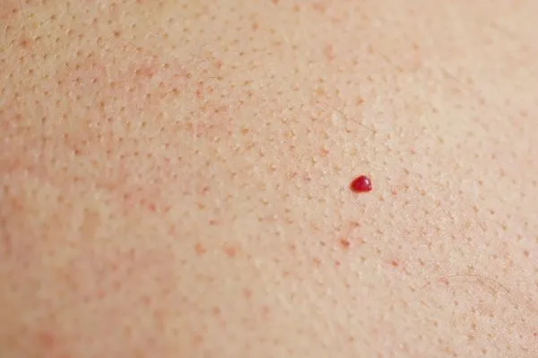 close up of a cherry angioma Weybridge