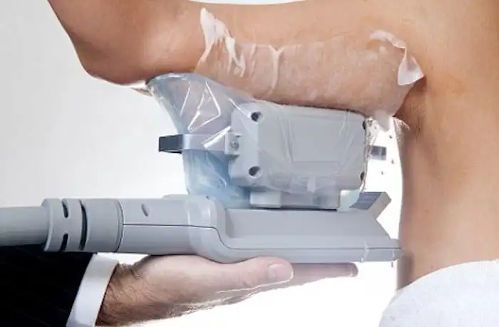 Picture of fat freezing Weybridge on the upper arms.