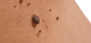 image of a skin tag Weybridge