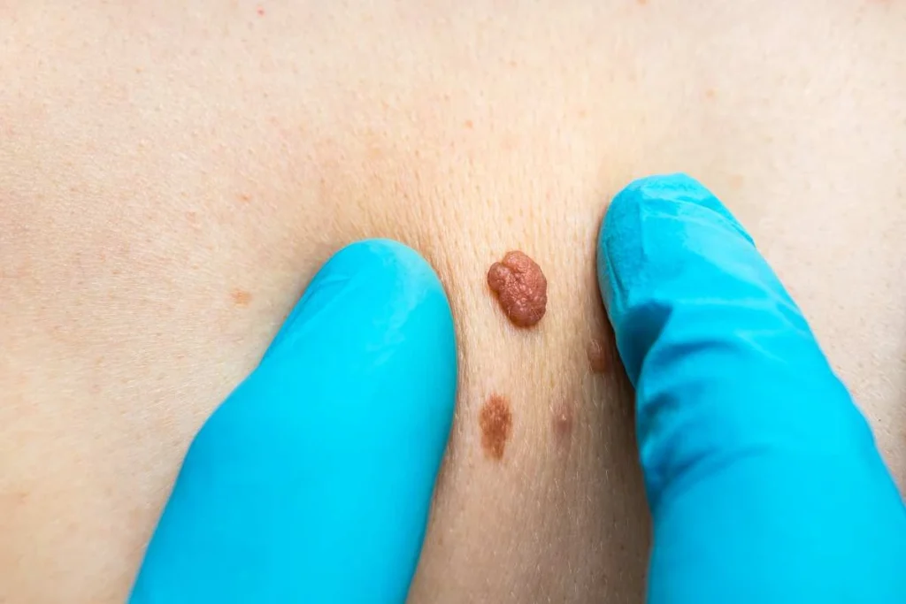 Consultant examining a skin tag Weybridge