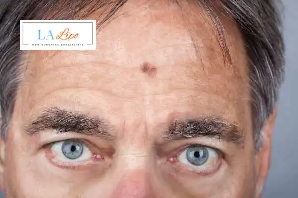 Solar Lentigo Removal Weybridge image of man with mark on his forehead