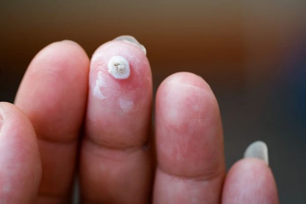 wart on person finger - cryotherapy to treat from LA LIPO Weybridge