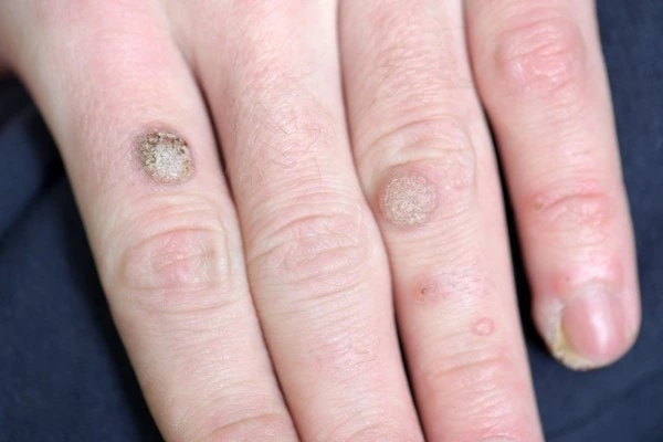 photo of warts on person hand - see wart removal Weybridge from LA LIPO