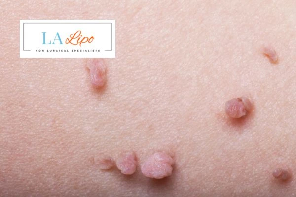Does cryopen skin tag removal Weybridge hurt? Find out now call our team today!