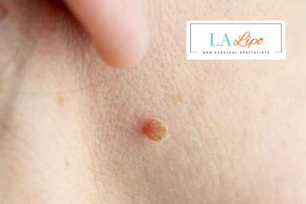 Book skin tag removal Weybridge today speak to our team now!