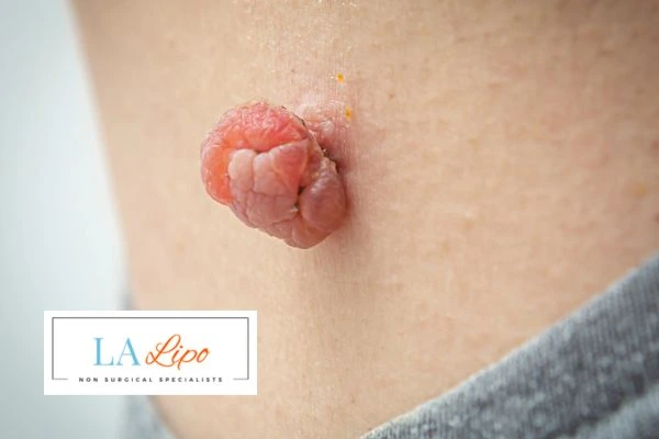 Interested in skin tag removal Weybridge? Concerned about the pain? Find out more today!