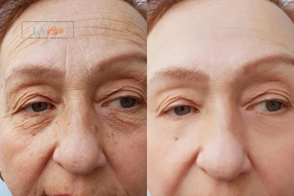 The powerful benefits of Morpheus8 Treatment Weybridge - Call Our team today!