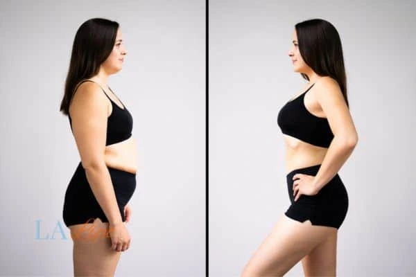 Picture of womans before and after using LA-EMS body sculpting to improve her core strength Weybridge