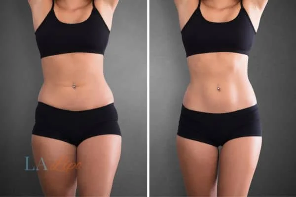 before and after results of non-surgical treatment to help a woman's body image and mental health Weybridge
