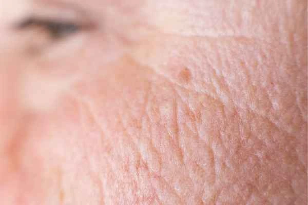 close up picture of a woman's face showing an age spot Weybridge