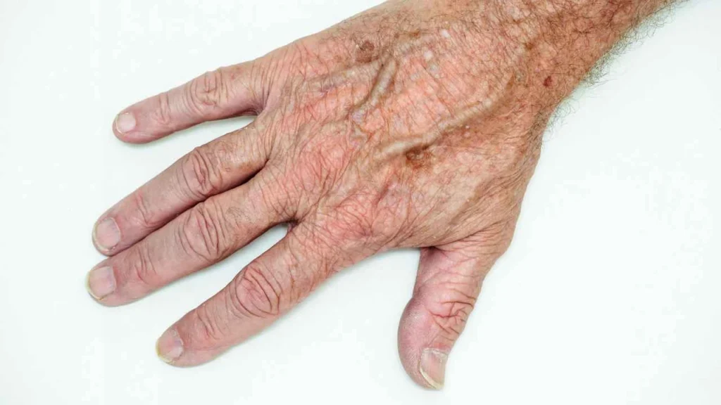 Male hand showing age spot Weybridge