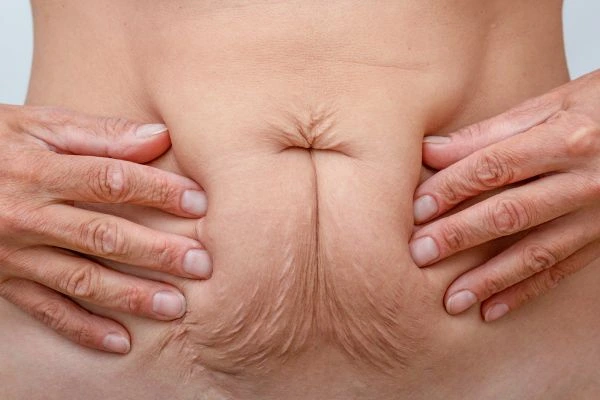 Image of a woman's stomach with loose skin - example of skin tightening Weybridge options