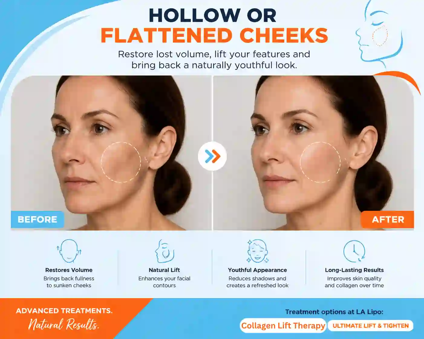 Sign #4: Hollow or Flattened Cheeks Weybridge