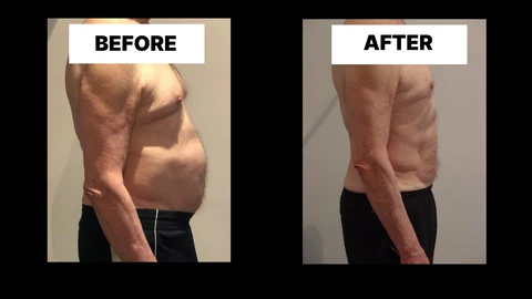 What Symptoms Can Diastasis Recti Cause in Men? Weak Core, Back Pain and Poor Posture Weybridge